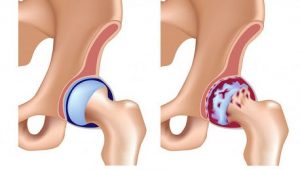 Biểu hiện của viêm khớp dạng thấp