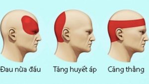 Loại bỏ cơn đau đầu không dùng thuốc trong 5 phút