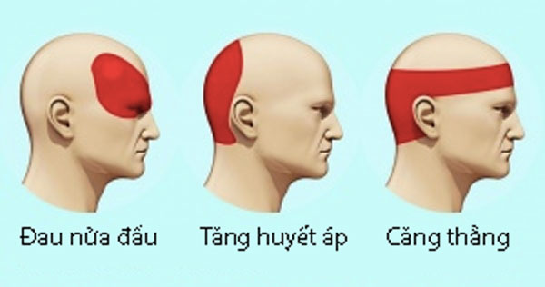 Loại bỏ cơn đau đầu không dùng thuốc trong 5 phút