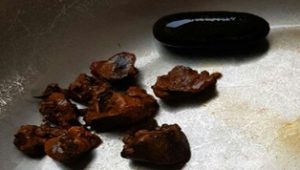 PHẪU THUẬT LẤY SỎI ỐNG MẬT CHỦ VÀ SỎI TÚI MẬT